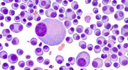New Drug Will Be Studied in Relapsed/Refractory Myeloma, Other Blood Cancers