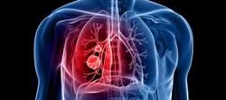 Screening After a Lung Cancer Diagnosis