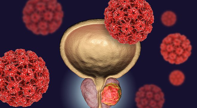 PSMA-Targeted Therapy May Decrease PSA Levels in Metastatic Prostate Cancer Subset - Vimarsana News