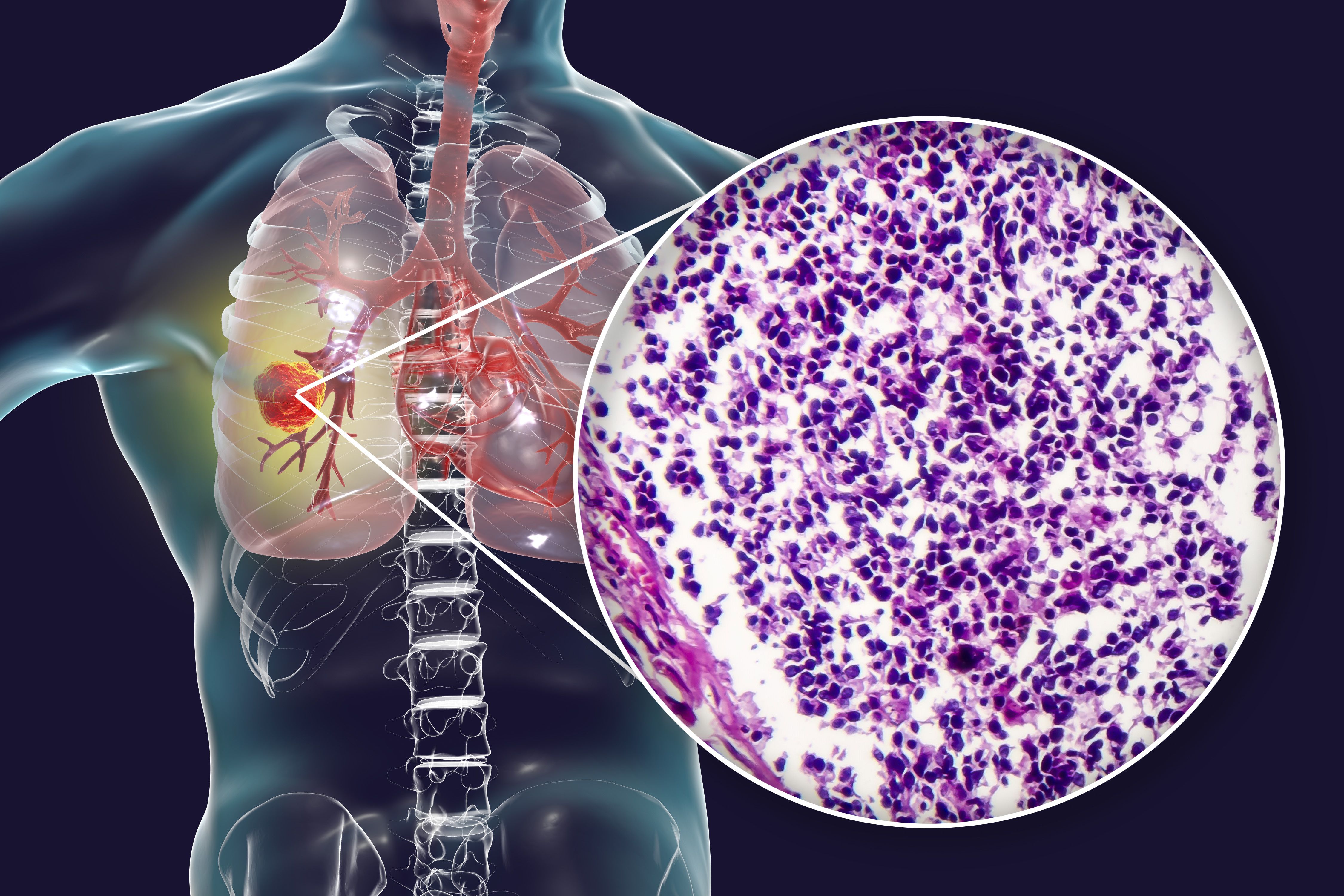 Imfinzi May Contribute to LongTerm Survival Improvements in
