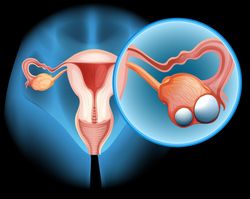Rivoceranib-Based Therapy Improves Outcomes in Recurrent Ovarian Cancer 