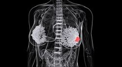 Kisqali Plus Endocrine Therapy Improves Early Breast Cancer Outcomes
