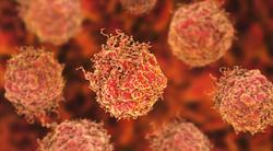 Metastasis-Directed Therapies May Lead to a Delay in Disease Progression for Some Patients With Prostate Cancer