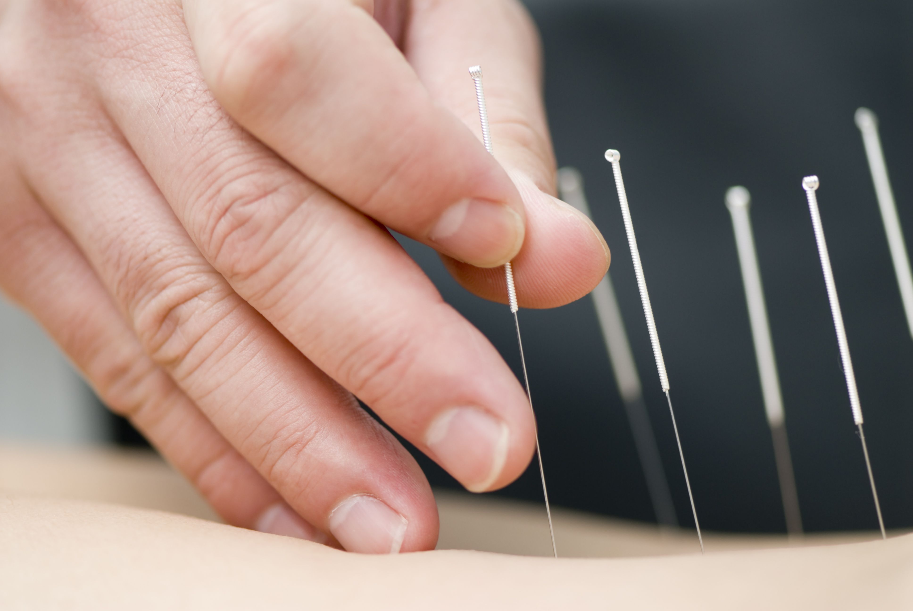 Acupuncture Can Improve Sleep for Cancer Survivors With Chronic Pain - Vimarsana News