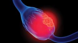 Ongoing Trial Shows Positive Response Rates With MEK Inhibitor Combo in Ovarian Cancer Subset