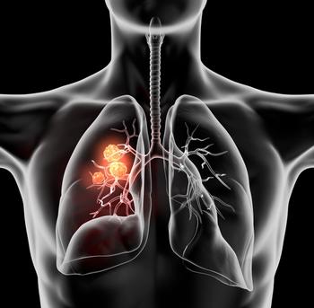 Aumolertinib Improves Survival in Advanced Non-Small Cell Lung Cancer