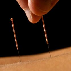 Acupuncture Is a ‘Worthwhile’ Approach to Decrease Cancer-Related Pain, Expert Says