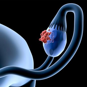 Less Invasive Techniques Gaining Traction in Ovarian Cancer Prevention