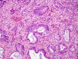 Combination of Rybrevant and Chemotherapy Improves Survival for Some Patients with NSCLC - Vimarsana News