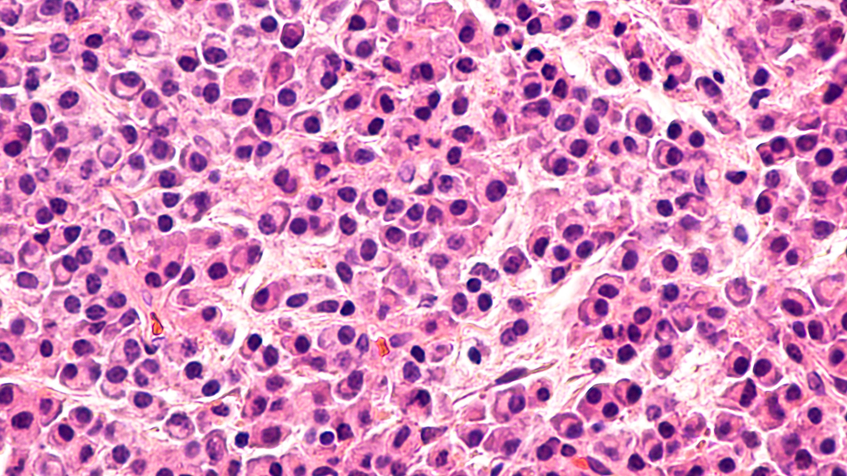 Elranatamab Elicits Responses in Pretreated Relapsed/Refractory Myeloma - Vimarsana News