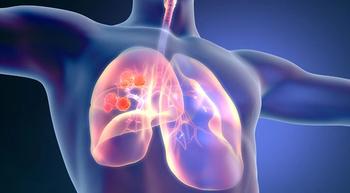 Addition of Tiragolumab to Tecentriq-Chemo Combo Fails to Boost Outcomes in Small Cell Lung Cancer