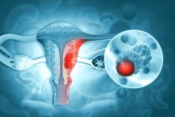 Adding Jemperli to Chemo Lengthens Time to Progression in Early Endometrial Cancer