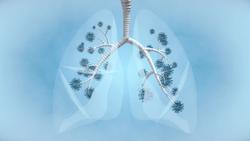 A Glimmer of Hope for Those With Lung Cancer