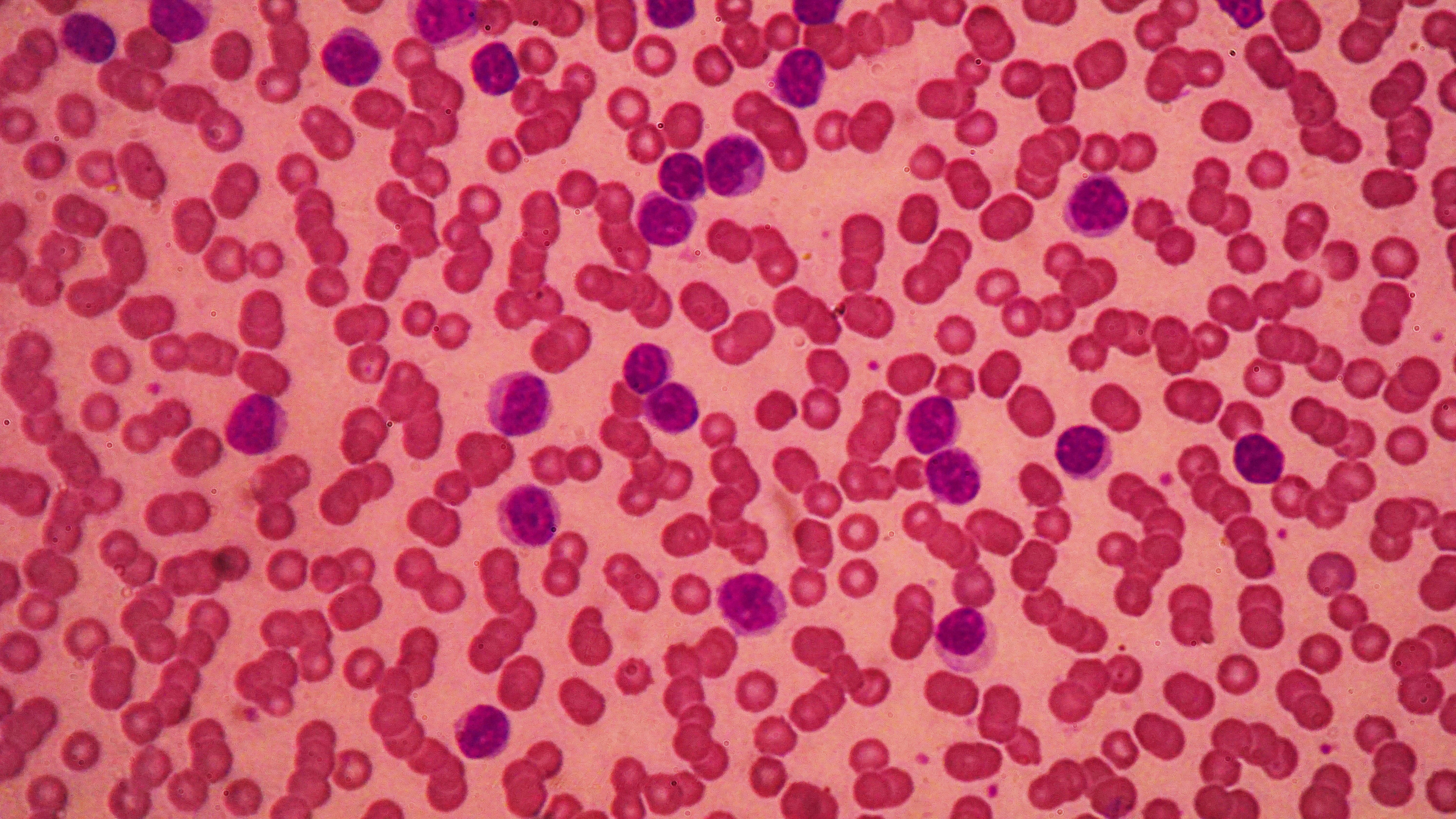 Breyzani Benefits Previously Treated SLL, CLL - Vimarsana News