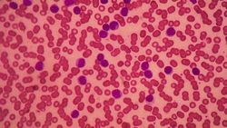First Patient Receives Investigational Cancer Drug-Combination for Relapsed/Refractory Acute Myeloid Leukemia
