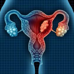 Lenvima Plus Keytruda Bests Chemotherapy for Advanced Endometrial Cancer