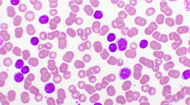 Pre- or Post-Transplant Xospata Shows Relapse-Free Survival Benefit in AML Group - Vimarsana News