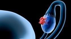 Ovarian Cancer Trial to Study IMNN-001, Chemotherapy Combination