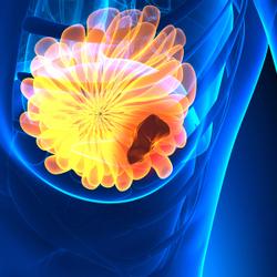 Kisqali Plus Endocrine Therapy May Reduce Breast Cancer Recurrence Risk